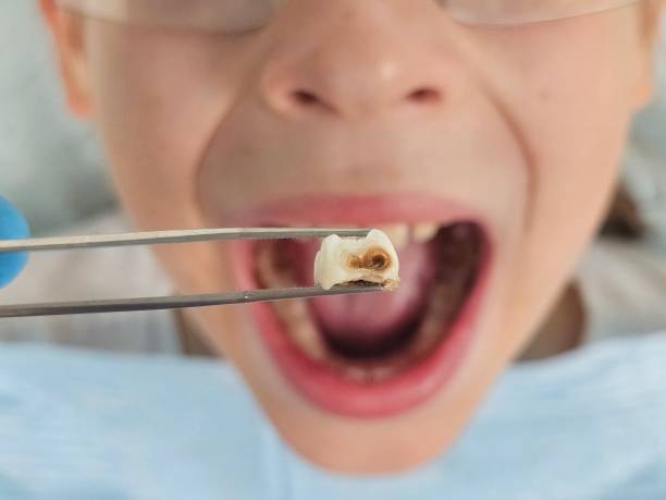 Best Emergency Root Canal Treatment in Smackover, AR